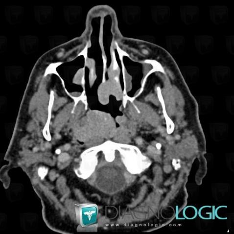 Plasmacytoma, Nasal cavity / Nasopharynx, CT