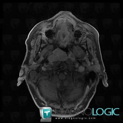 Plasmacytoma, Nasal cavity / Nasopharynx, MRI