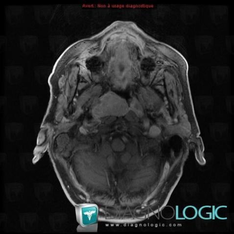 Plasmacytoma, Nasal cavity / Nasopharynx, MRI