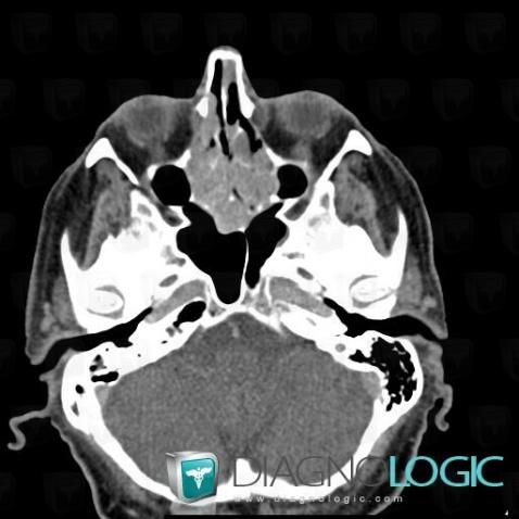 Plasmacytoma, Sinus, CT