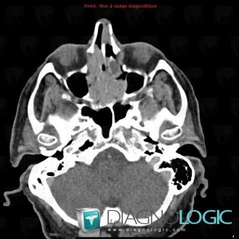 Plasmacytoma, Sinus, CT