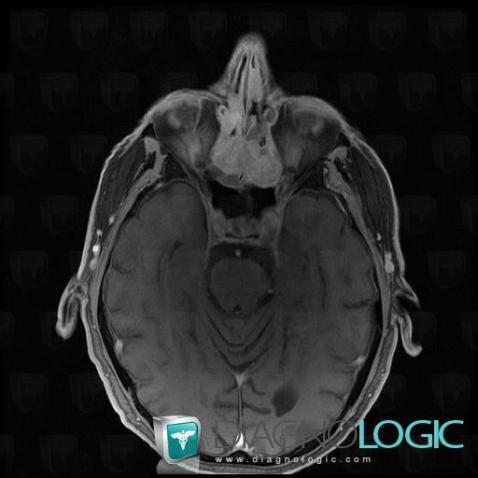 Plasmacytoma, Sinus, MRI