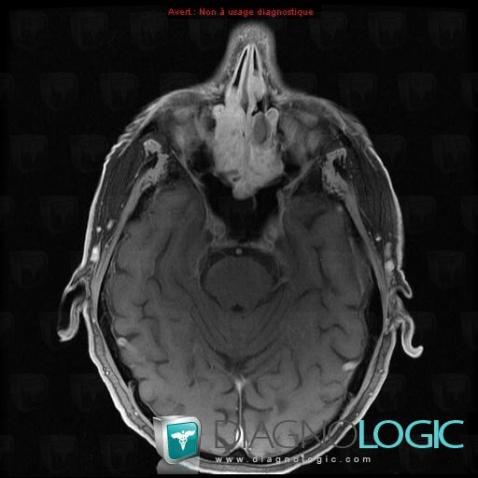 Plasmacytoma, Sinus, MRI