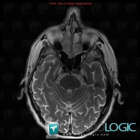 Plasmacytoma, Sinus, MRI