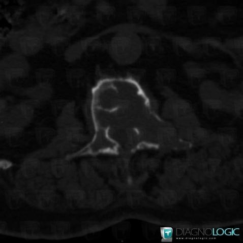 Plasmacytoma, Vertebral body / Disk, CT