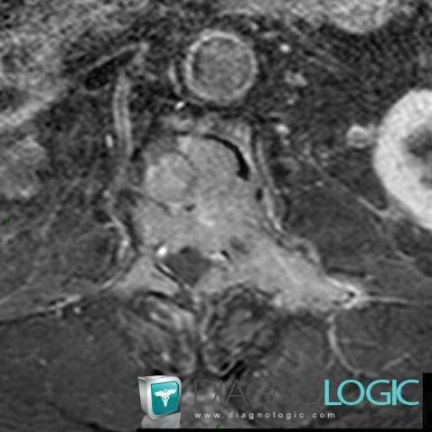 Plasmacytoma, Vertebral body / Disk, MRI