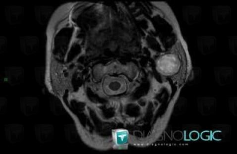 Pleomorphic adenoma, Parotid and other salivary glands, MRI