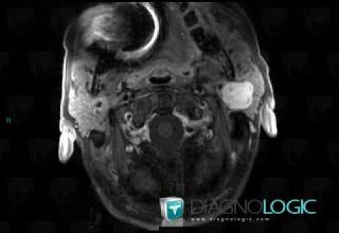 Pleomorphic adenoma, Parotid and other salivary glands, MRI