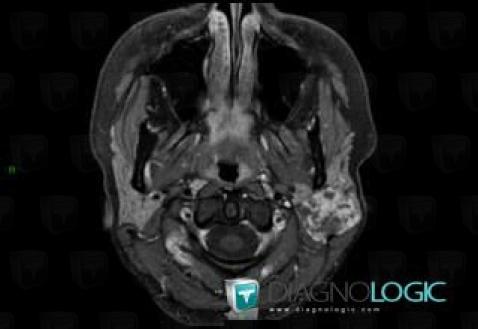 Pleomorphic adenoma, Parotid and other salivary glands, MRI