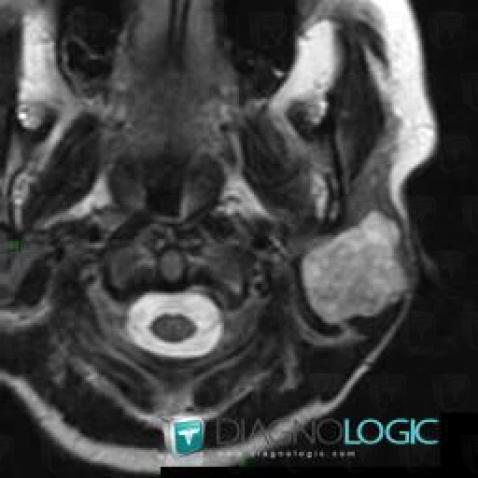 Pleomorphic adenoma, Parotid and other salivary glands, MRI