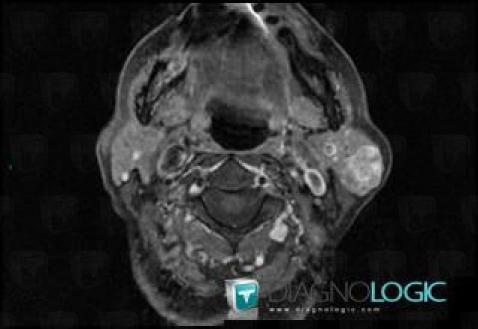 Pleomorphic adenoma, Parotid and other salivary glands, MRI