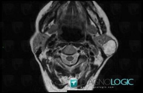 Pleomorphic adenoma, Parotid and other salivary glands, MRI