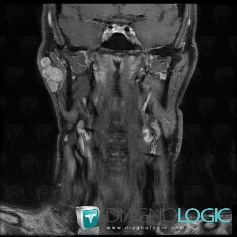 Pleomorphic adenoma, Parotid and other salivary glands, MRI