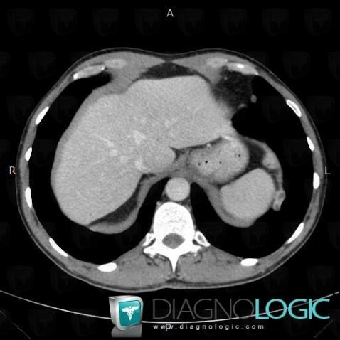 Pleural carcinomatosis, Diaphragm, CT