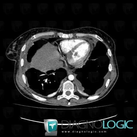 Pleural carcinomatosis, Pleura, CT