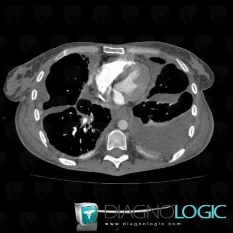 Pleural carcinomatosis, Pleura, CT