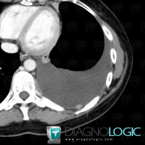 Pleural carcinomatosis, Pleura, CT