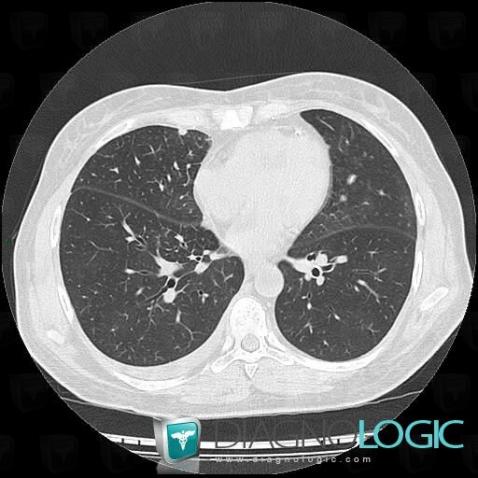 Pleural carcinomatosis, Pleura, CT