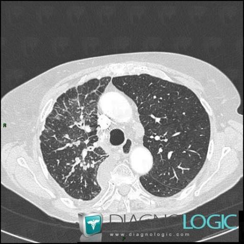 Pleural carcinomatosis, Pleura, CT