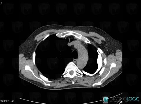 Pleural effusion, Pleura, CT