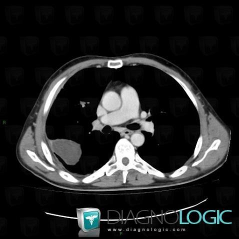 Pleural effusion, Pleura, CT