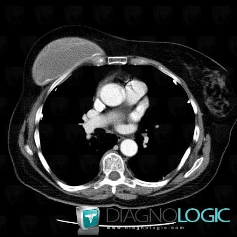 Pleural plaque, Pleura, CT