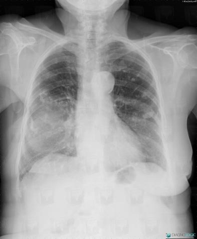 Pleural plaque, Pleura, X rays