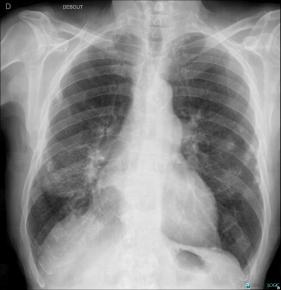 Pleural plaque, Pleura, X rays
