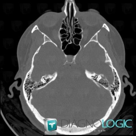 Pneumocephalus, Infratentorial peri cerebral spaces, CT