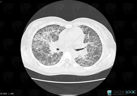 Pneumocystose, Parenchyme pulmonaire, Scanner