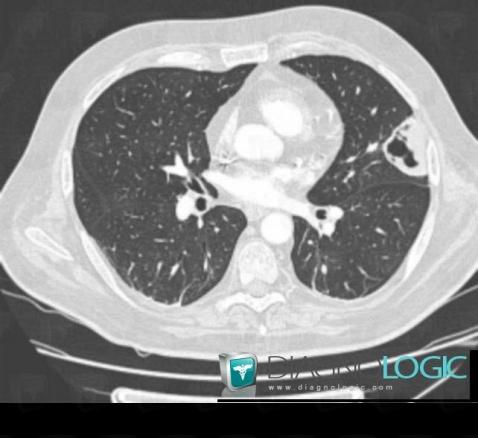 Pneumocystose, Parenchyme pulmonaire, Scanner