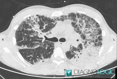 Pneumocystose, Parenchyme pulmonaire, Scanner