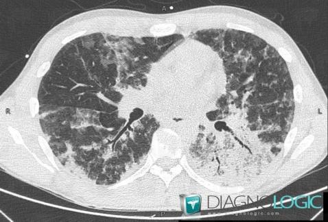 Pneumocystose, Parenchyme pulmonaire, Scanner