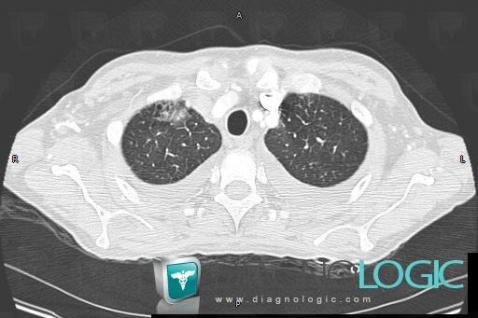 Pneumocystose, Parenchyme pulmonaire, Scanner