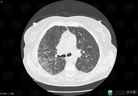 Pneumocystose, Parenchyme pulmonaire, Scanner