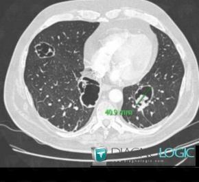 Pneumocystosis, Pulmonary parenchyma, CT