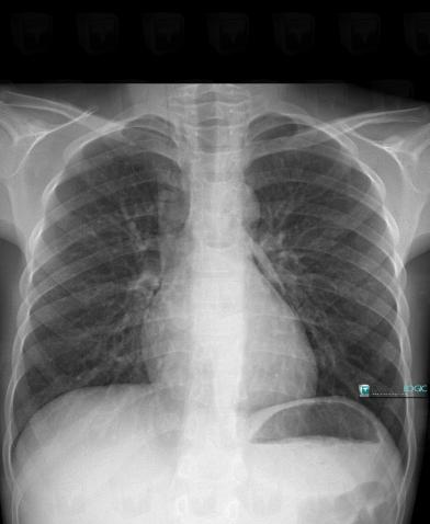 Pneumomédiastin, Médiastin, Radio