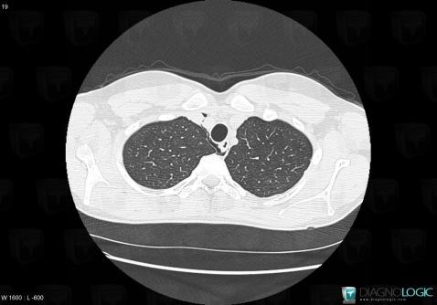 Pneumomédiastin, Médiastin, Scanner