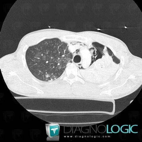 Pneumomediastinum, Mediastinum, CT