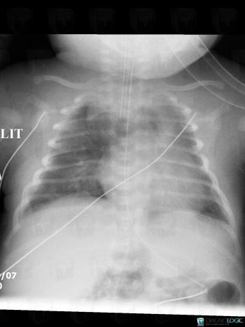 Pneumomediastinum, Mediastinum, X rays