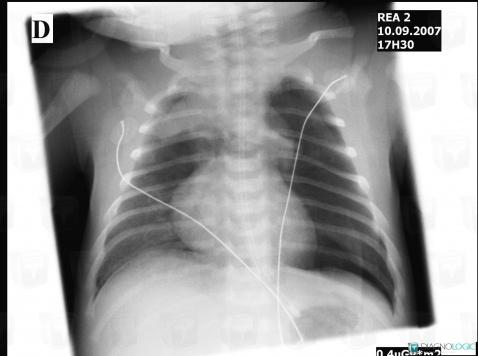Pneumomediastinum, Mediastinum, X rays