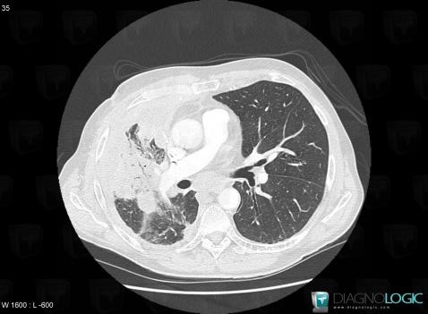 Pneumonie infectieuse fréquente, Parenchyme pulmonaire, Scanner