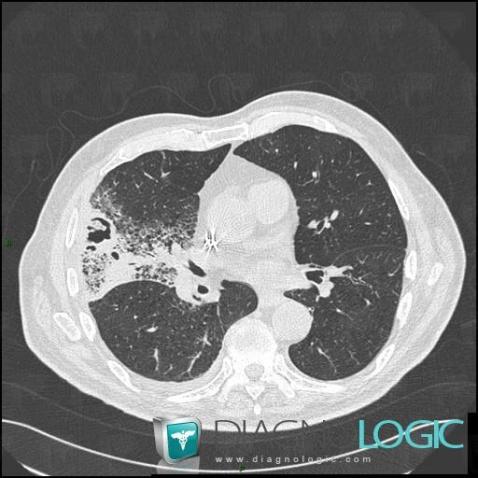 Pneumonie infectieuse fréquente, Parenchyme pulmonaire, Scanner