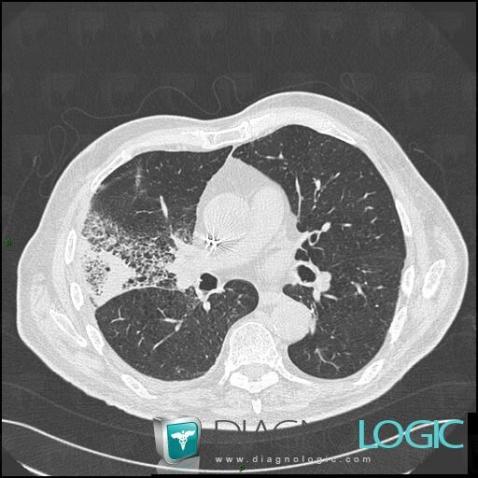 Pneumonie infectieuse fréquente, Parenchyme pulmonaire, Scanner