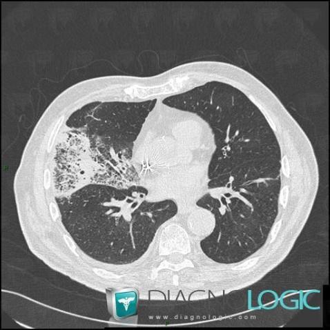 Pneumonie infectieuse fréquente, Parenchyme pulmonaire, Scanner