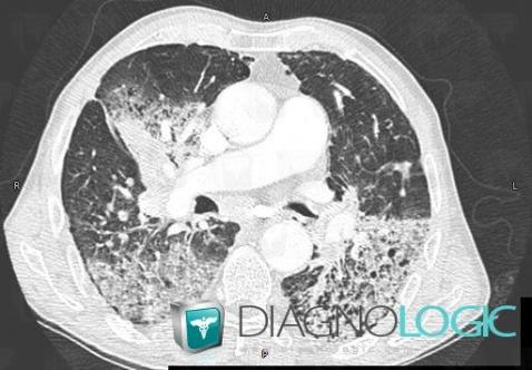 Pneumonie infectieuse fréquente, Parenchyme pulmonaire, Scanner