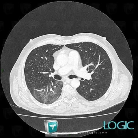 Pneumonie infectieuse fréquente, Parenchyme pulmonaire, Scanner