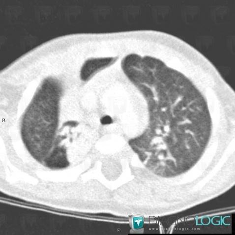 Pneumonie infectieuse fréquente, Parenchyme pulmonaire, Scanner