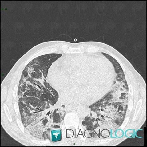 Pneumonie interstitielle aiguë, Parenchyme pulmonaire, Scanner