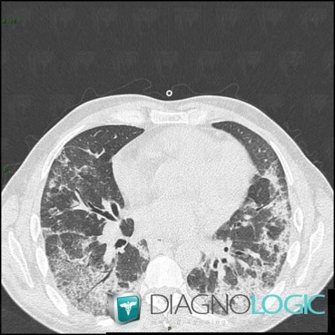 Pneumonie interstitielle aiguë, Parenchyme pulmonaire, Scanner